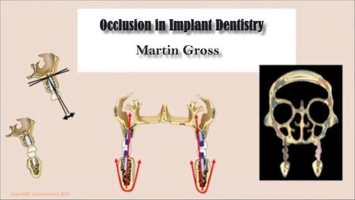 Occlusion in Implant Dentistry