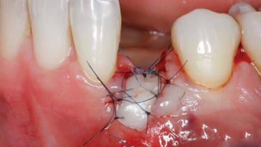 Gidedental Soft Tissue Management around Natural Teeth and Dental Implants 2020 (CME VIDEOS)