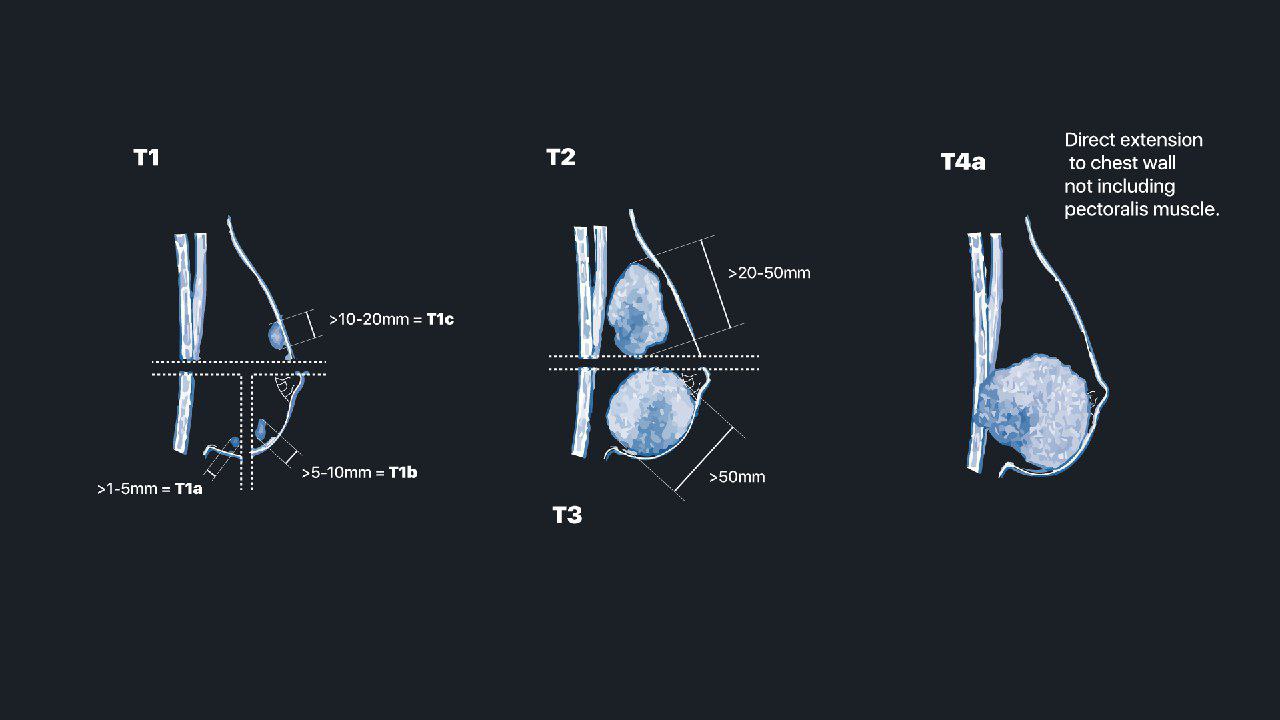 MRIOnline Mastery Series: Evaluation of Newly Diagnosed, Pre-Operative Breast Cancer Patients 2021 (CME VIDEOS)