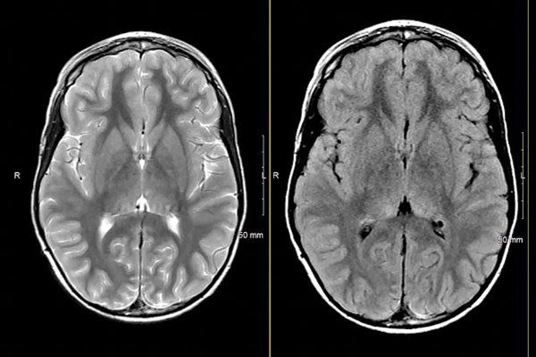 MRIOnline Mastery Series: Neurofibromatosis Type 1 (NF1) 2021 (CME VIDEOS)