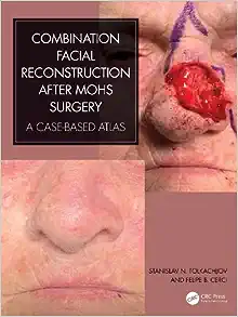 Combination Facial Reconstruction after Mohs Surgery: A Case Based Atlas (PDF Book)