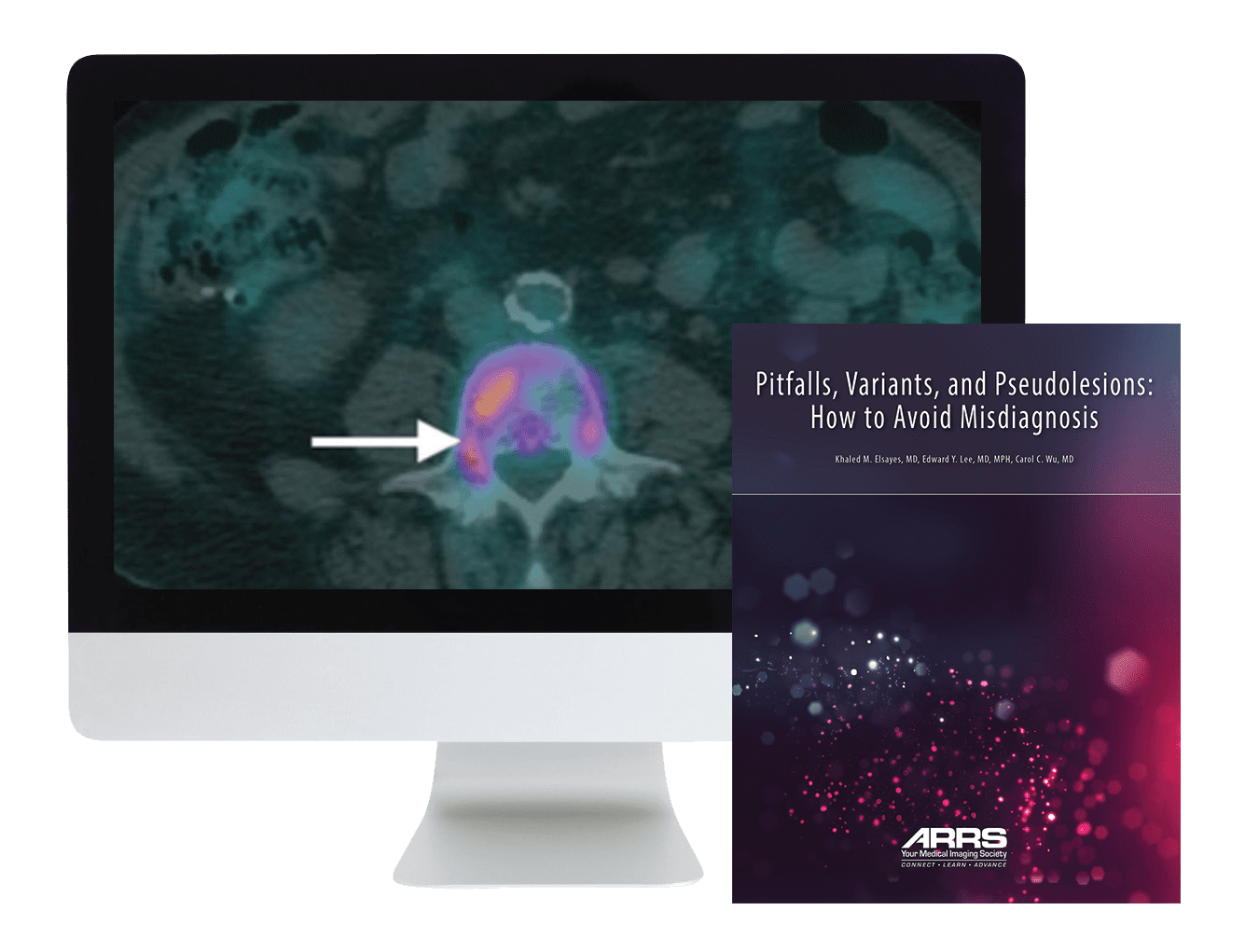 ARRS Pitfalls, Variants, and Pseudolesions: How to Avoid Misdiagnosis 2019