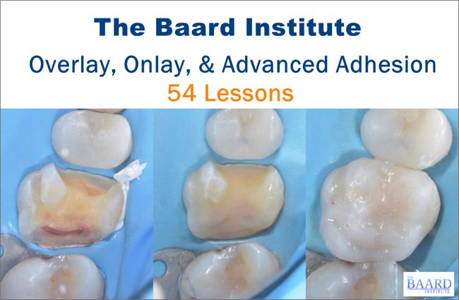 The Baard Institute Overlay, Onlay, & Advanced Adhesion