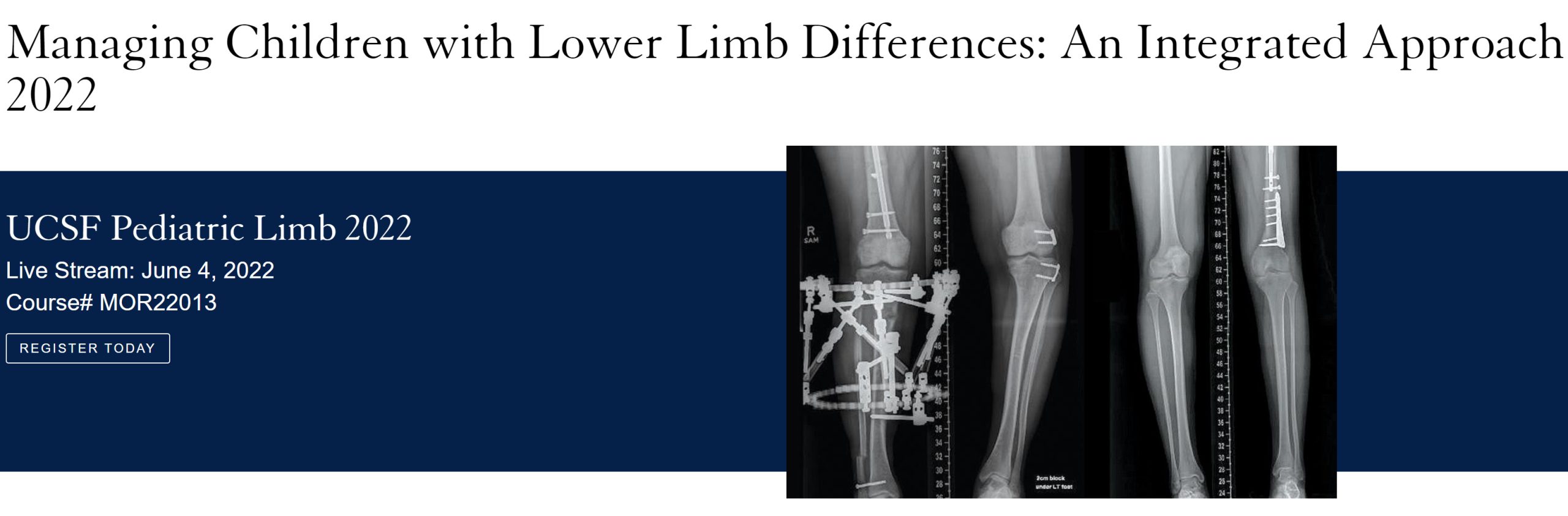 Managing Children with Lower Limb Differences: An Integrated Approach 2022