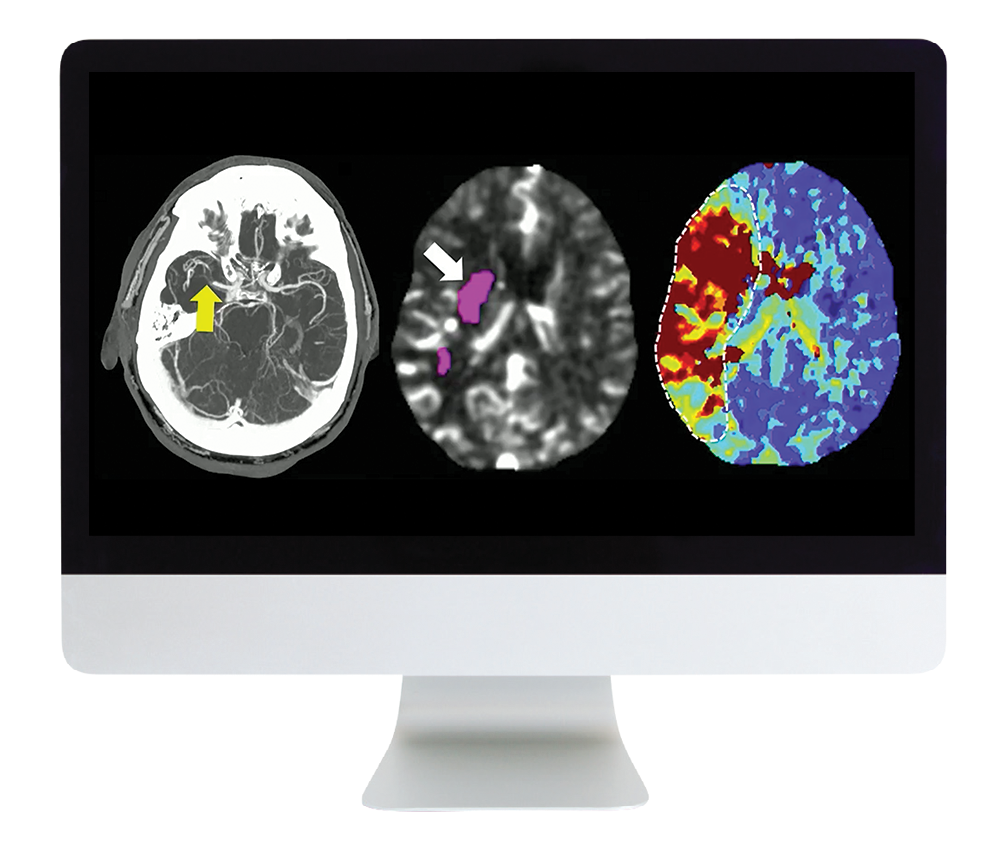 ARRS Code Stroke: What Every Radiologist Should Know 2022 (Videos)
