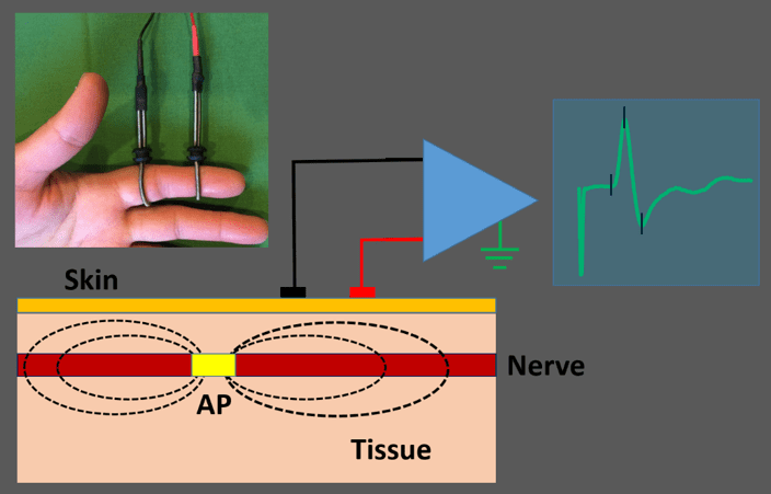 Essential EDX Series: Volume II Insertional and Spontaneous Activity