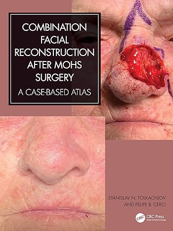 Combination Facial Reconstruction After Mohs Surgery: A Case Based Atlas (Original PDF From Publisher)