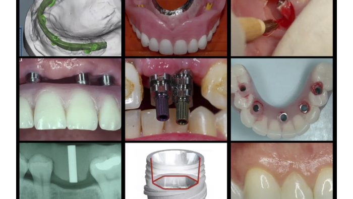 Gidedental A-Z in Restorative Implant Dentistry (CME VIDEOS)